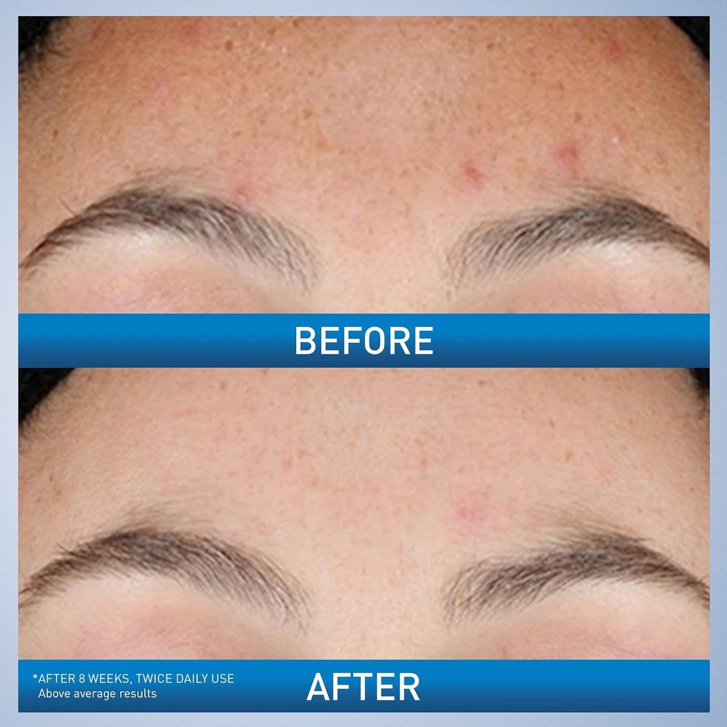 CeraVe Resurfacing Retinol Serum 30ml – For Post-Acne Marks, Smooth & Even Skin