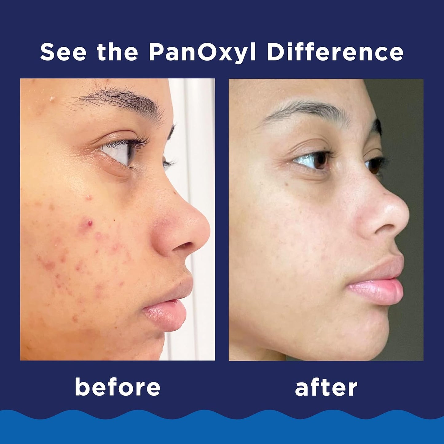 PanOxyl Acne Wash – 4% & 10% Benzoyl Peroxide Face & Body Cleanser for Acne Treatment