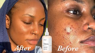Glycolic Acid 7% Toning Solution – The Ordinary UAE | Exfoliating Toner